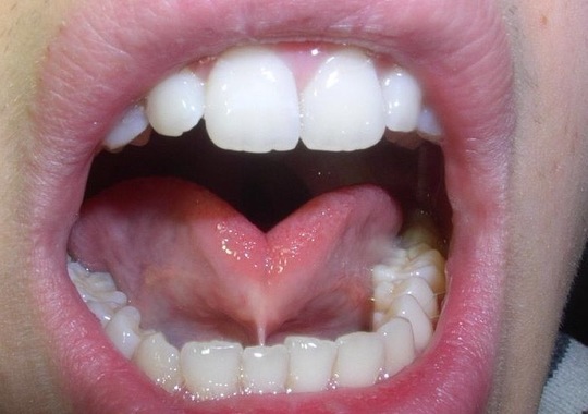の 痛い が 舌 真ん中
