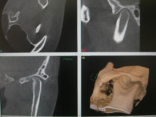 歯科用CTでどのような診査が可能になったか スマイルデンタル