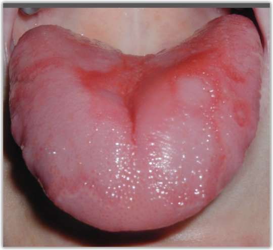 舌 黒毛 黒毛舌：病因、症状、治療と予防